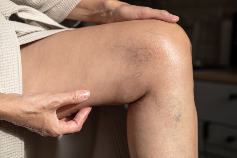 Spider Veins