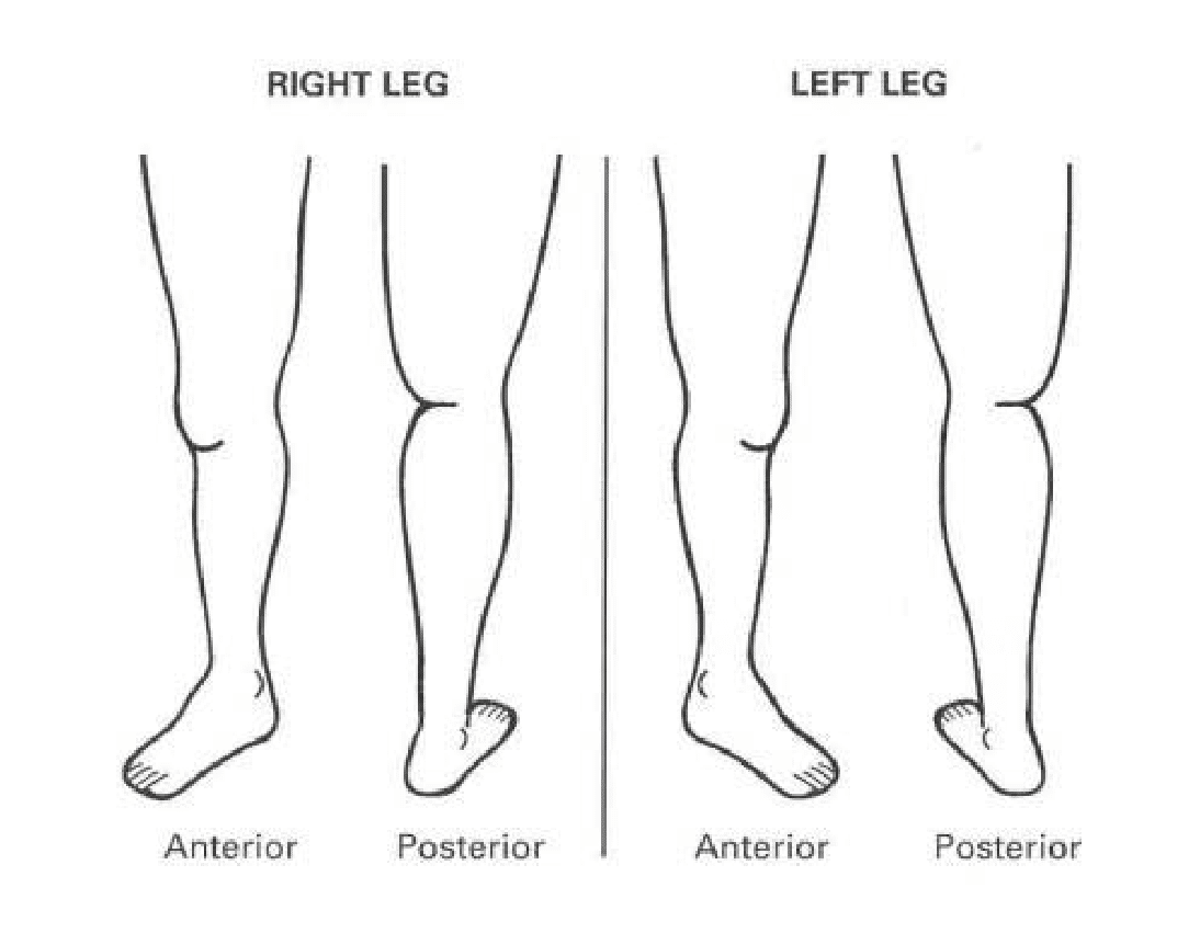 Vein Screening Diagram - Right and Left Leg (Anterior and Posterior)